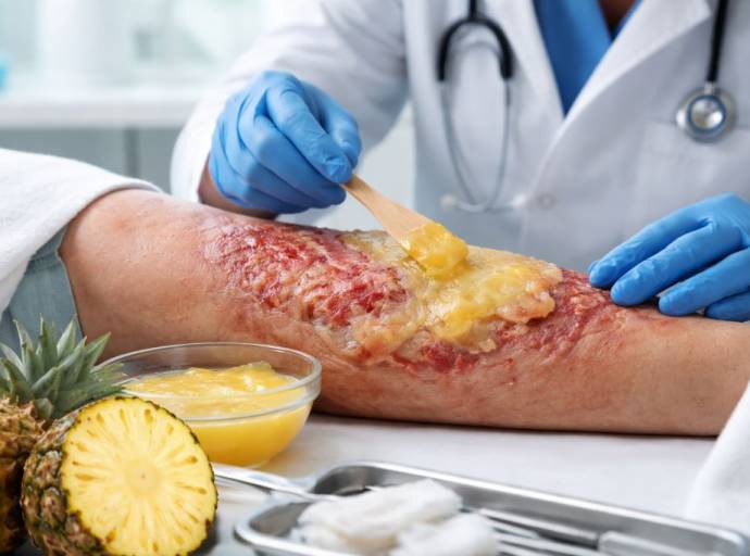 Bromelina, cos’è e come viene utilizzata nei centri ustioni: il ruolo del debridement enzimatico nelle ustioni gravi